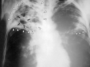 tuberculosis